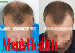 Men's Health 2016 Artikel Alamouti Haartransplantation