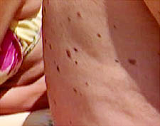 Hautkrebsvorsorge - Schutz vor Hautkrebs - Muttermale