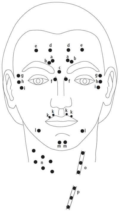 Injektionsstellen von Botx im Gesicht und am Hals