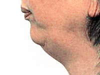 Halsstraffung, Doppelkinn, Truthahnhals, Fettabsaugung und -entfernung im Gesichts- und Halsbereich